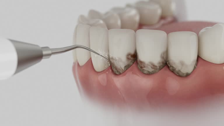 Trusted Dental Crowns And Bridges service in Mendota, IL - Dentist Open Now